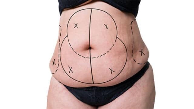 abdominoplastie fleurs de lys tunisie