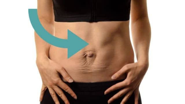 abdominoplastie tunisie