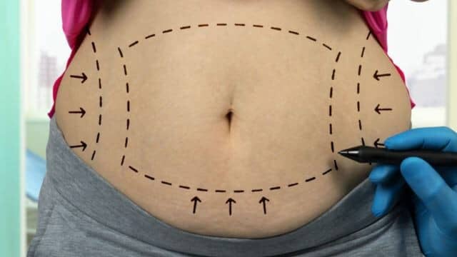 abdominoplastie tunisie