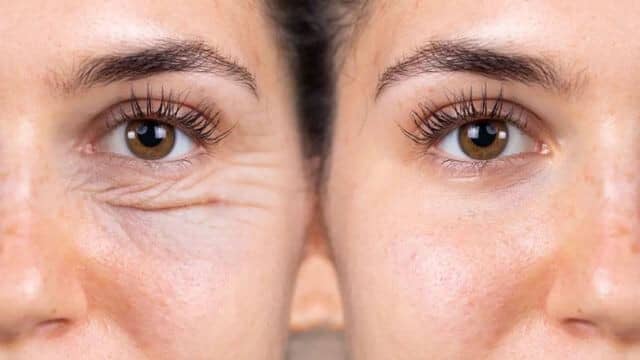 blepharoplastie tunisie