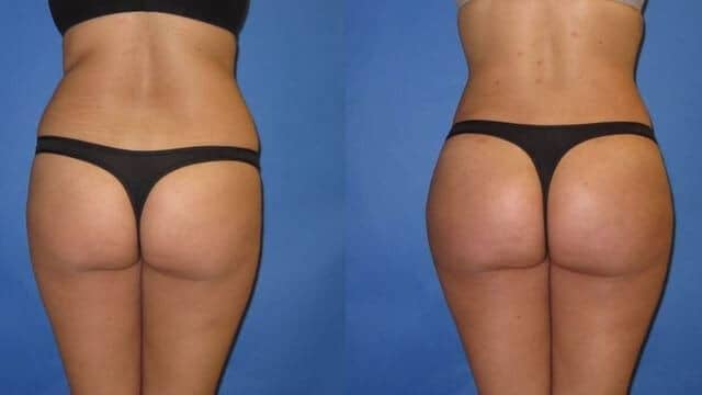 BBL brazilian butt lift