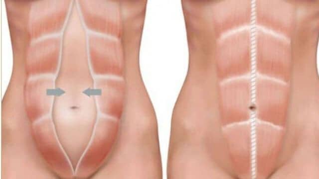 diastasis des grands droits