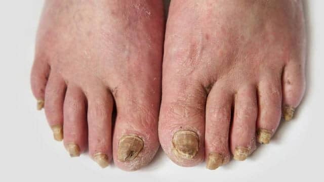 chirurgie esthétique pied moche