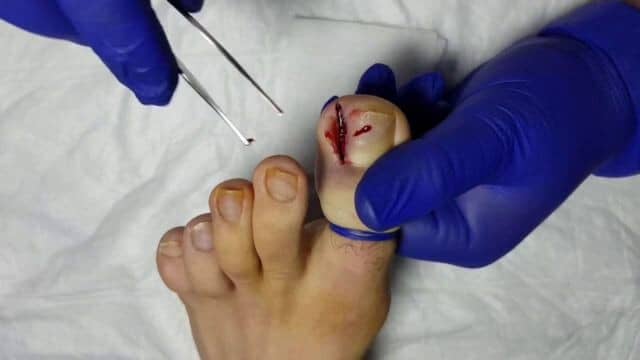 chirurgie esthétique pied moche