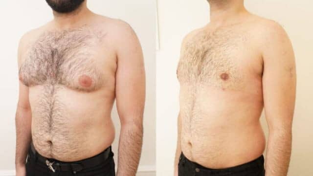 gynecomastie tunisie
