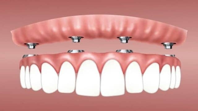implant dentaire Tunisie