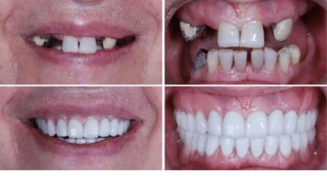 implant dentaire Tunisie