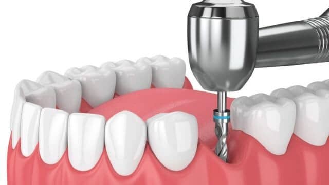 pose implant dentaire