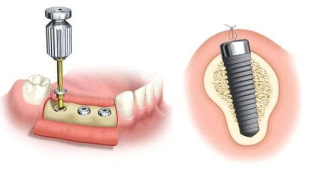 pose implant dentaire
