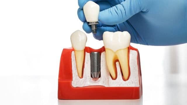 pose implant dentaire
