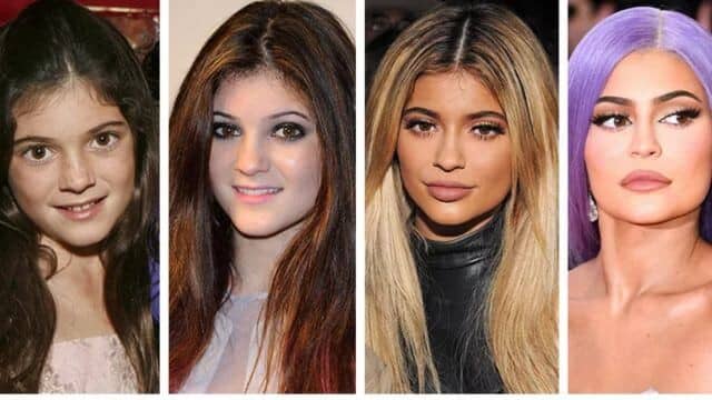 kylie jenner chirurgie esthétique