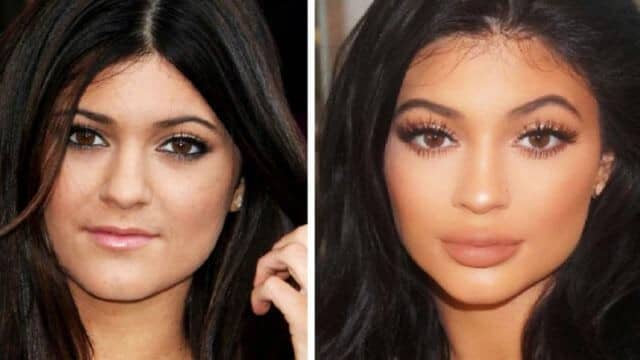 kylie jenner chirurgie esthétique