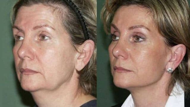 lifting cervico-facial tunisie