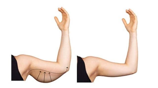 lifting bras tunisie