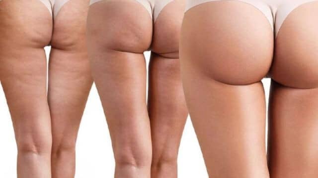 lifting fesses tunisie