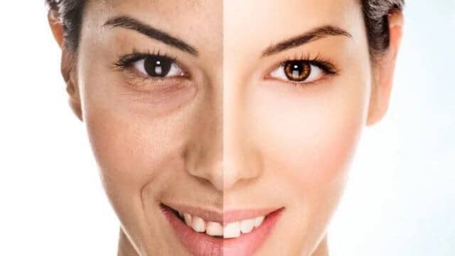 lipofilling visage tunisie