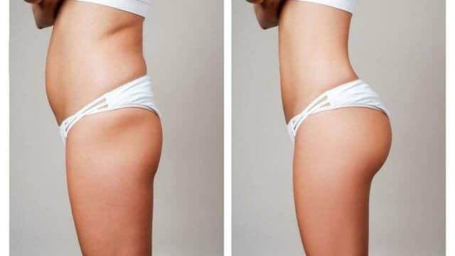 lipofilling fessiers tunisie