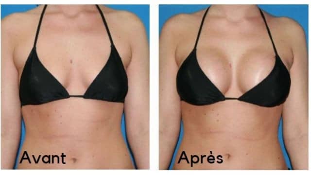 lipofilling seins tunisie