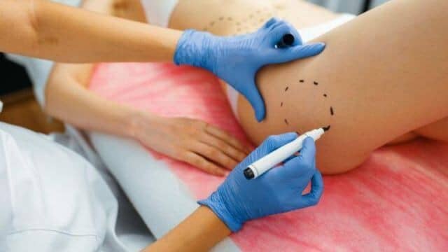 liposuccion cuisse tunisie