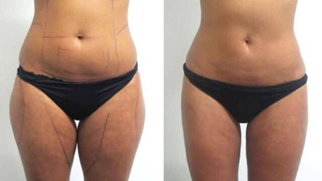 liposuccion cuisse tunisie