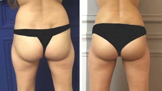 liposuccion culotte de cheval tunisie