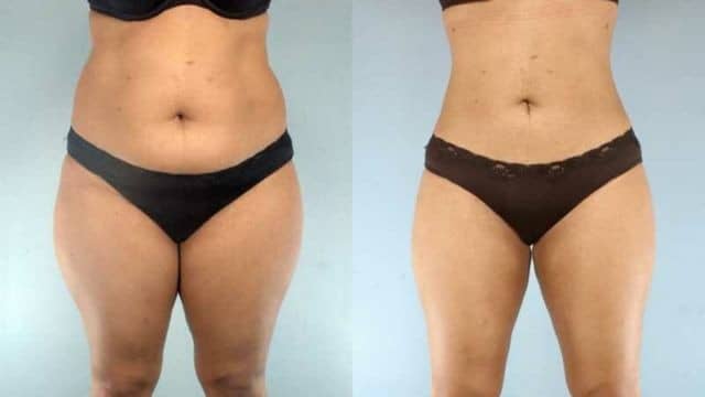 liposuccion hanche tunisie