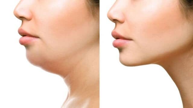 liposuccion menton