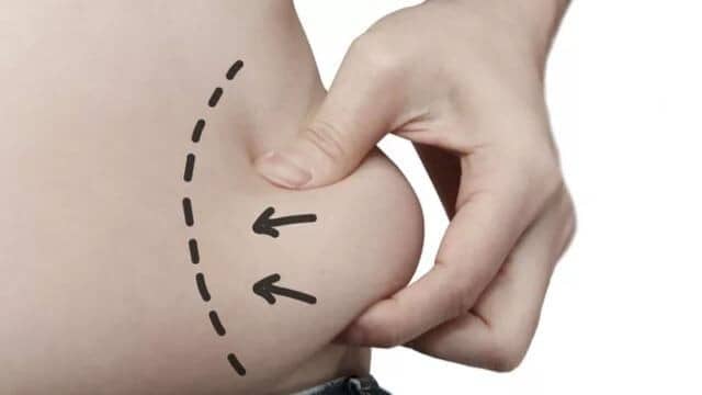 liposuccion poignees damour tunisie