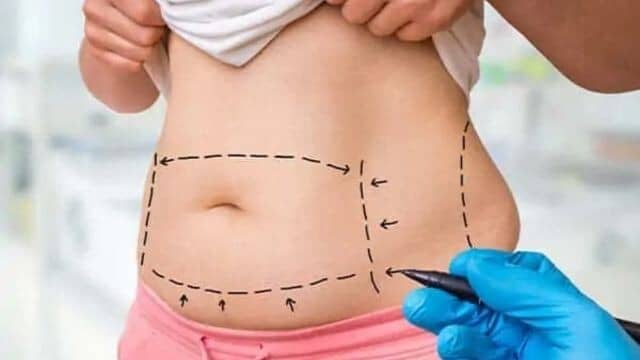 liposuccion ventre tunisie