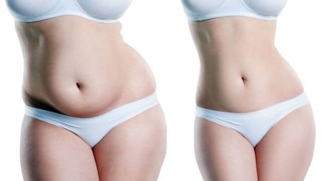 liposuccion ventre tunisie