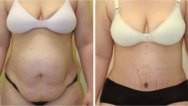 mommy makeover tunisie