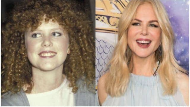 nicole kidman chirurgie esthétique