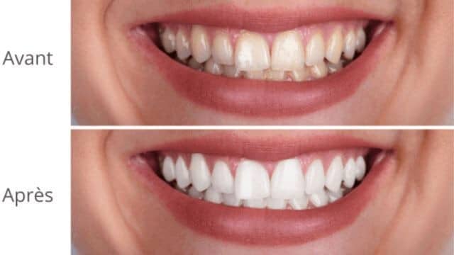combien coute un blanchiment des dents
