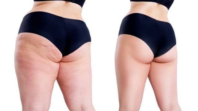prix pour une liposuccion des cuisses