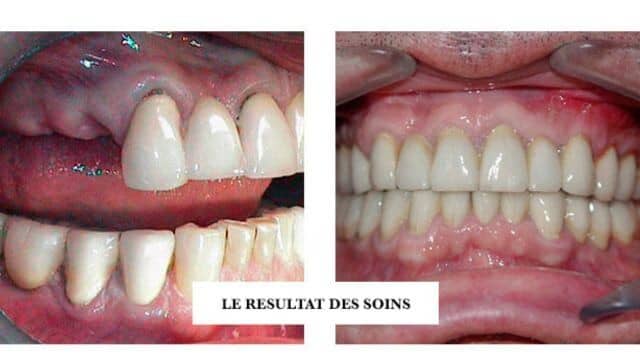 prothese dentaire tunisie