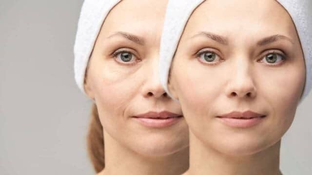 rajeunir visage injection acide hyaluronique