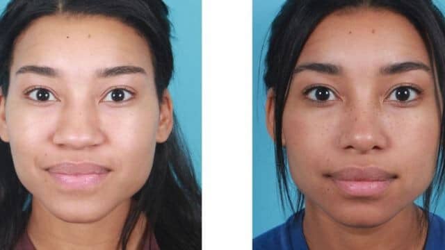 Rhinoplastie tunisie