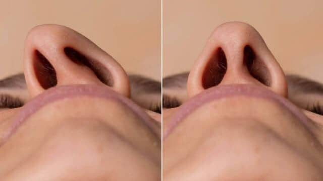 Rhinoplastie tunisie