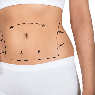 abdominoplastie tunisie idealmed
