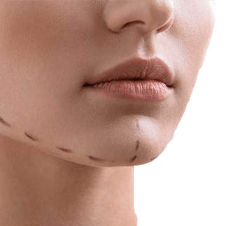 genioplastie tunisie idealmed