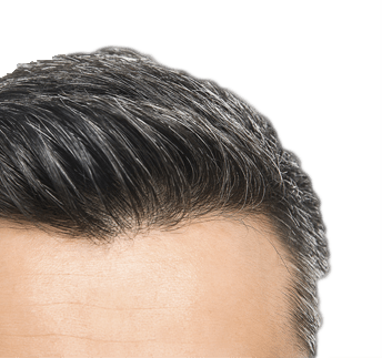 Greffe cheveux Tunisie | Idealmed Tunisie