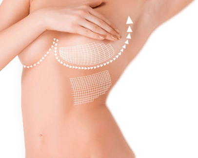 lifting seins tunisie idealmed