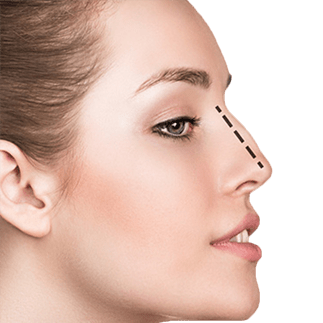 rhinoplastie tunisie idealmed