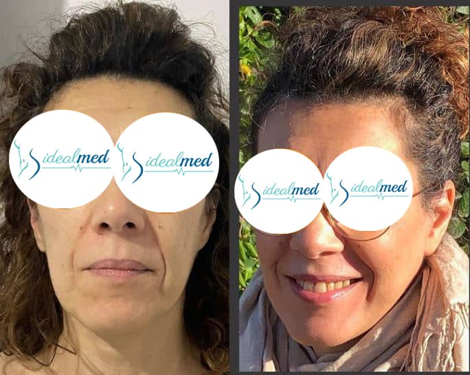 lipofilling visage Tunisie avant après